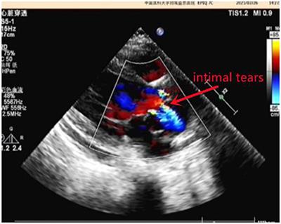 Case Report: Management of a 10-Year-Old Patient Who Presented With Infective Endocarditis and Stanford Type A Aortic Dissection